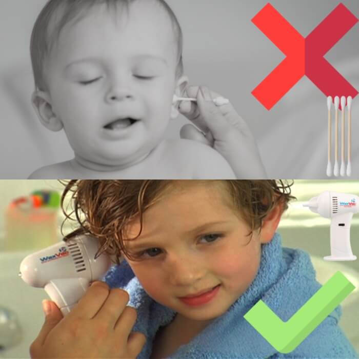 Comparação entre limpar com cotonete e limpar com o aspirador de cera WaxVac